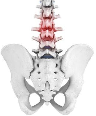Dolor lumbar agudo